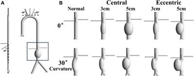 A hemodynamic analysis of energy loss in abdominal aortic aneurysm using three-dimension idealized model